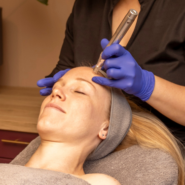 mesomicroneedling meso microneedling